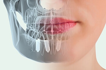 Implantes dentales en Sevilla | Clínica dental Julián Saiz