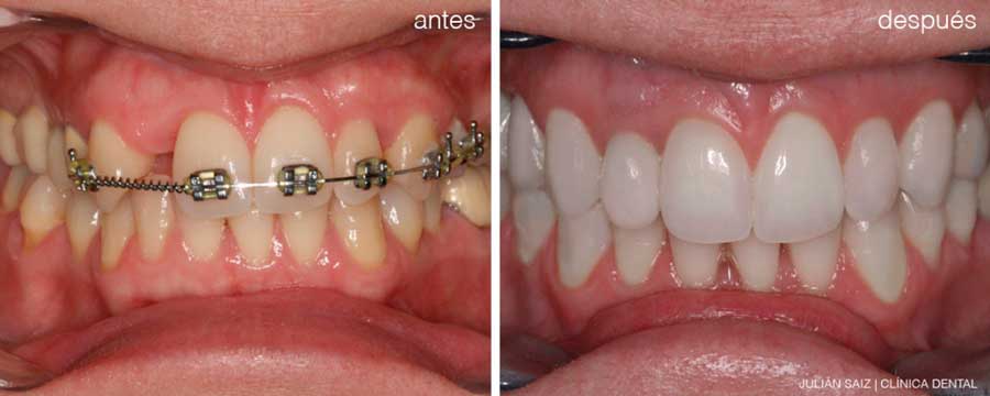 Implantes dentales y ortodoncia | Julián Saiz Clínica Dental