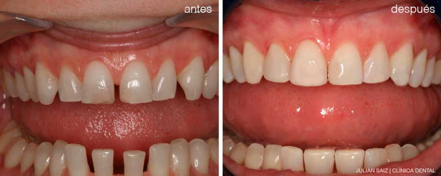 Estética dental | Julián Saiz Clínica Dental