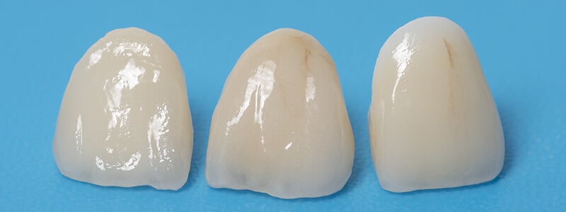 fractura dental