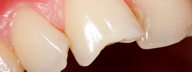 fractura dental