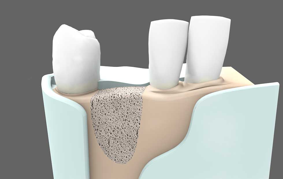 Cirugía oral | Regeneración ósea