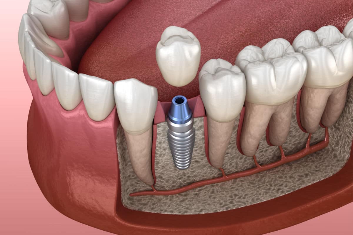¿En qué consiste la osteointegración de los implantes dentales? | Clínica Dental Julián Saiz