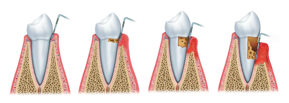 Fases de la enfermedad periodontal | Clínica Dental Julián Saiz