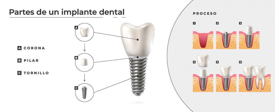 Ilustración de las partes de un implante dental, así como una representación del proceso de implantación en la boca. De esta forma, se sabe qué es un implante dental y cómo funciona.