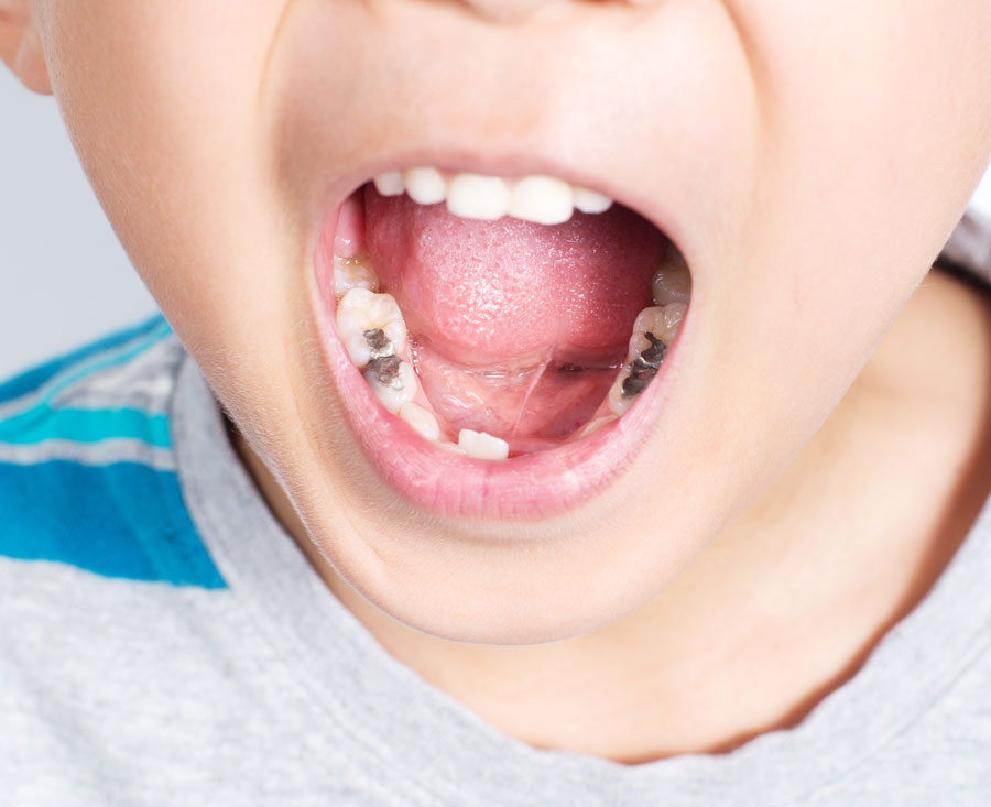 Niño con la boca muy abierta mostrando varios empastes de dientes