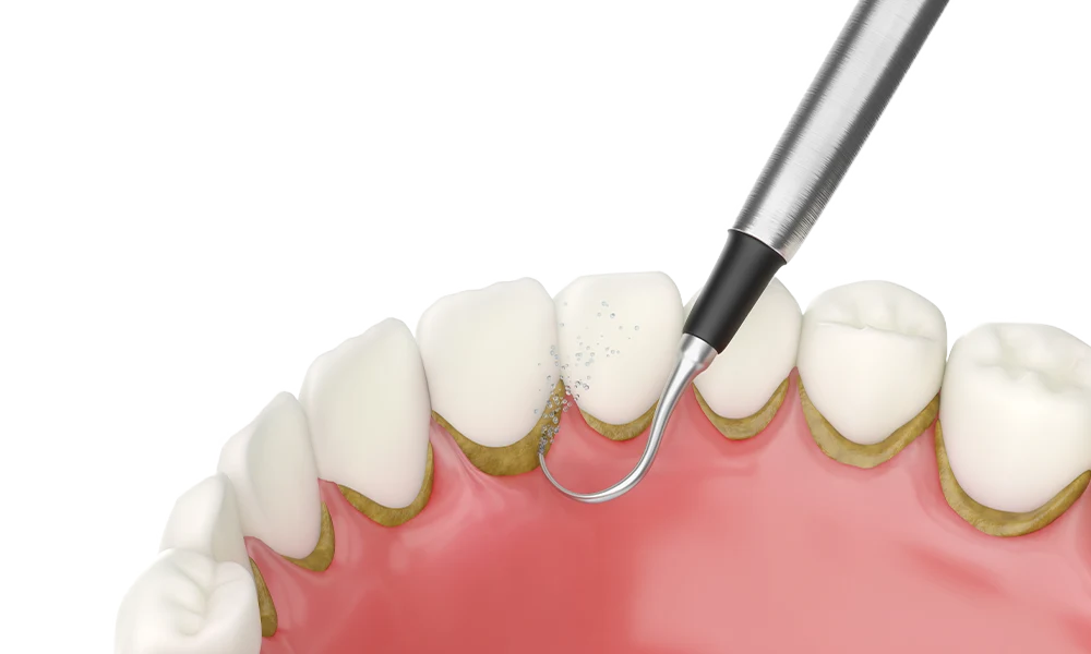 mantenimiento-preiodontal-ilustration Ilustracion de mantenimiento periodontal