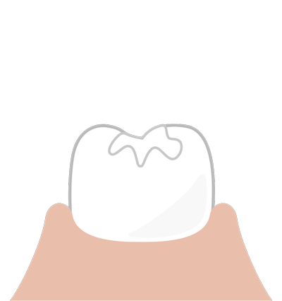 sellador-resina-compuesta