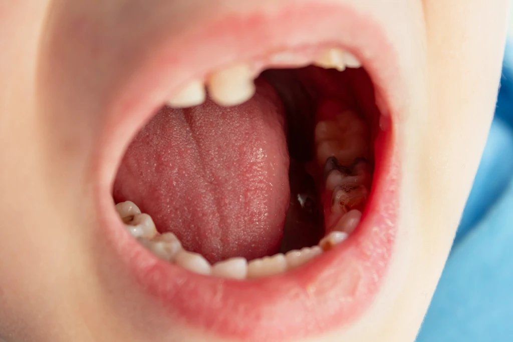 tratamiento-de-pulpectomia