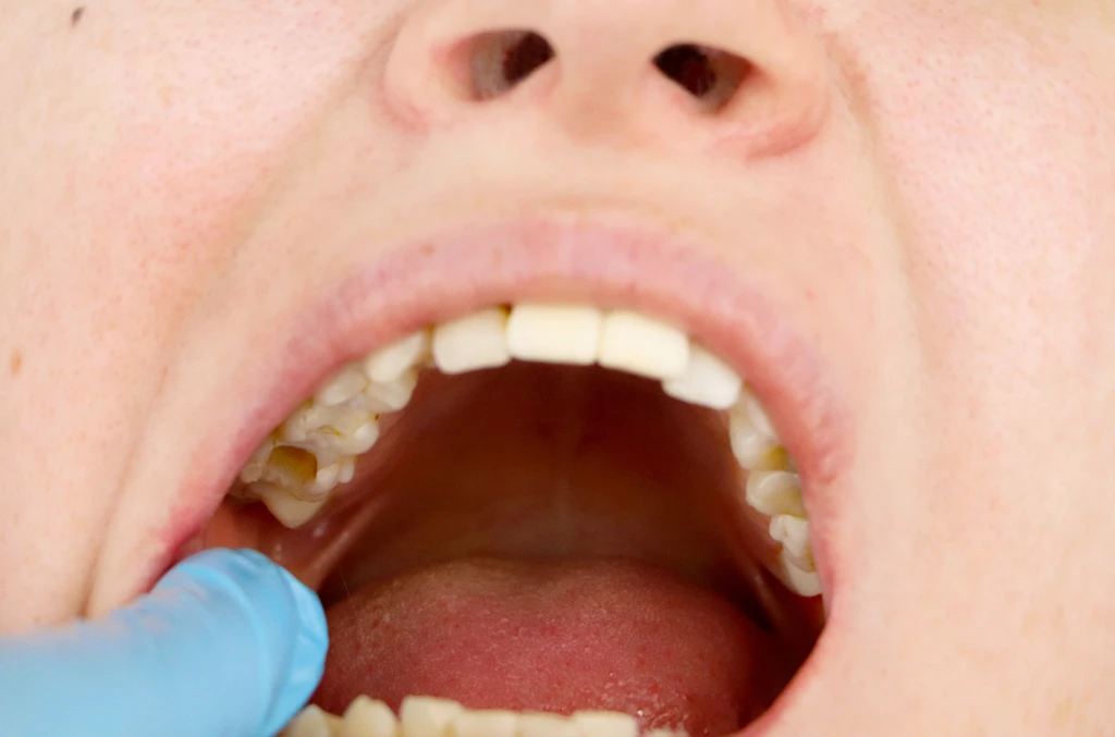 tratamiento-de-pulpotomia