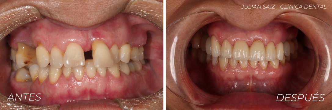 Caso clínico de implantes dentales y otros tratamientos dentales en Clínica dental Julián Saiz