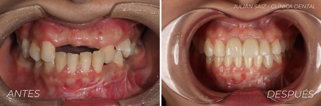 caso-fatima-implantes Caso clínico de implantes dentales en Clínica Dental Julián Saiz